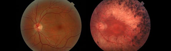 retinitis pigmentosa 2