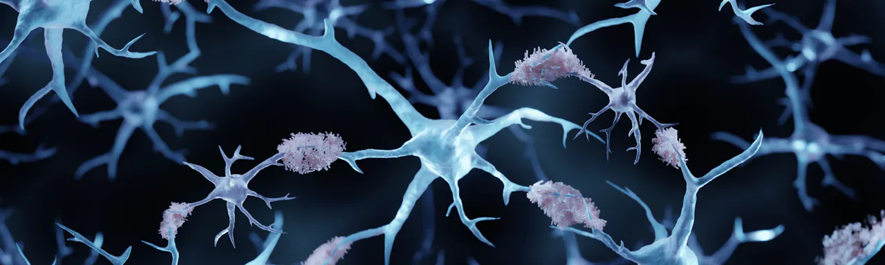 Amyloid plaque Alzheimer's disease
